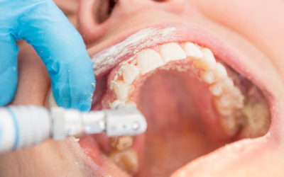 The True Cost of Dental Procedures: What You Need to Know Before Going to the Dentist