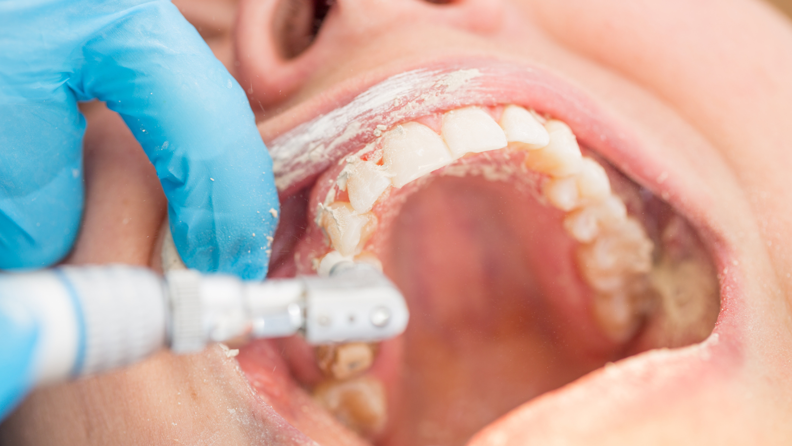 The True Cost of Dental Procedures