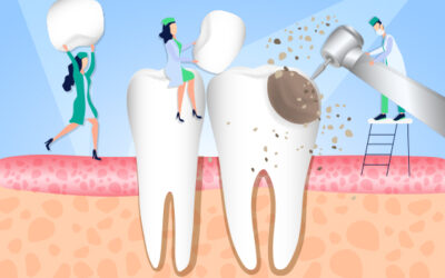 What do you do if a filling falls out of your tooth?