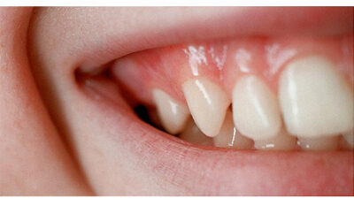 What Causes A Black Spot On Gums?